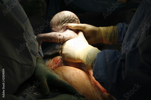 cesarean