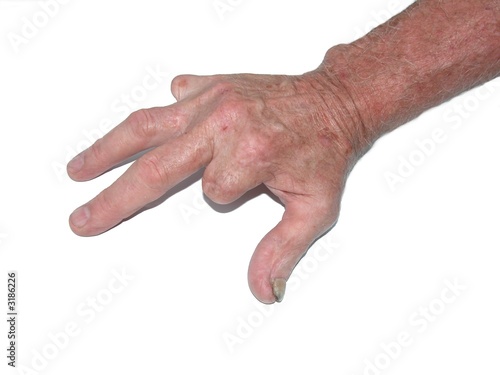 amputated fingers