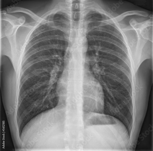 radiograph of chest