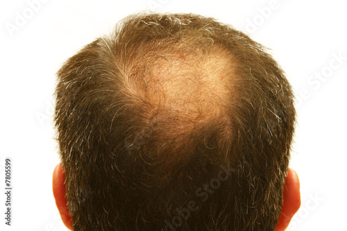 balding head