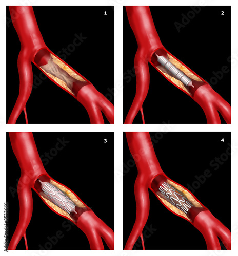 stent coronarico