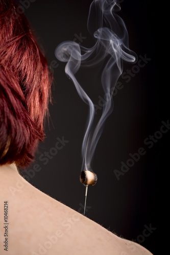 Woman's shoulder with smoking moxa on acupuncture needle
