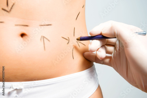 Marking abdomen for cosmetic correction surgery