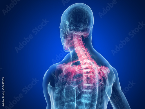 markierte Nackenschmerzen am menschlichen Skelett