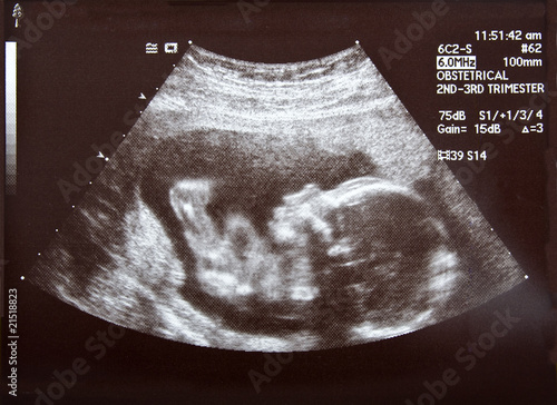 Ultrasound during second trimester