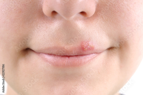 Close up of lips affected by herpes.