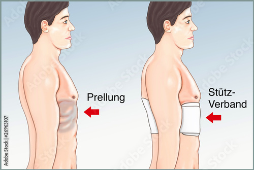 erste Hilfe bei Prellungen. Stuetzverband