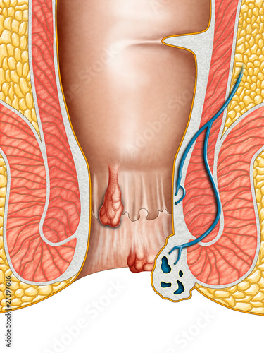 Hemorrhoids