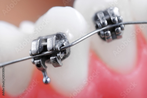 Dental braces super macro ,crooked teeth ,shallow depth of field
