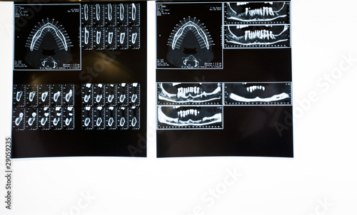 radiografia denti