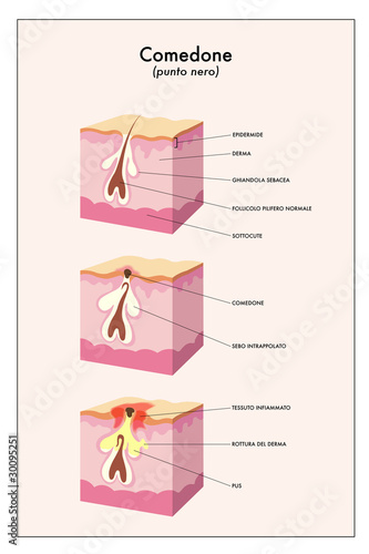 comedone