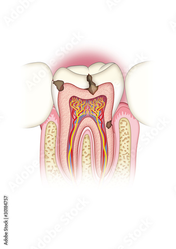 Odontología caries