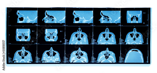 computer tomography of maxillary sinus. nasal septum deviation