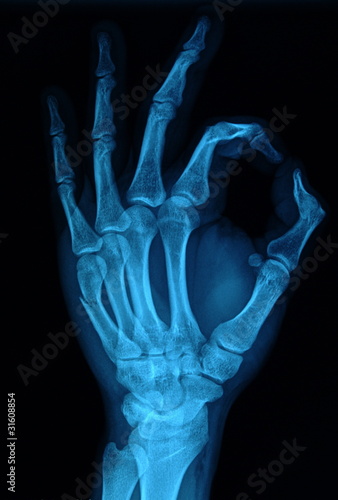 rentgen dłoń