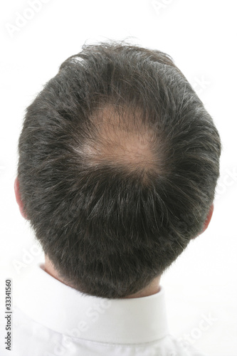 Tonsure-perte de cheveux