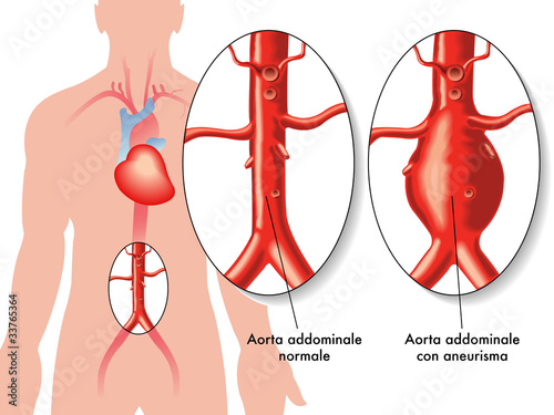 Aneurisma aorta addominale