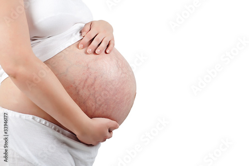 Stretch marks on pregnant woman's bump