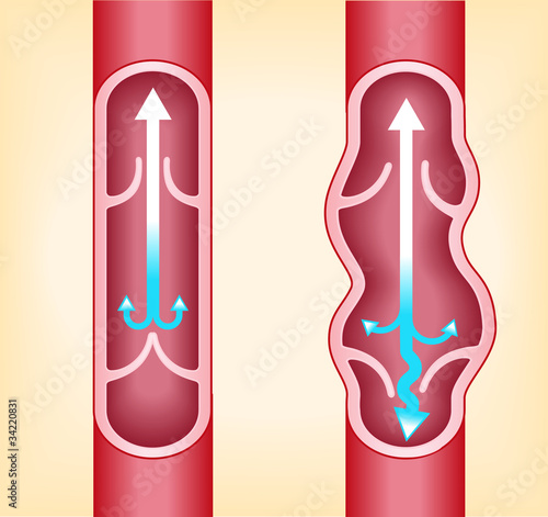 veins of the person under varices