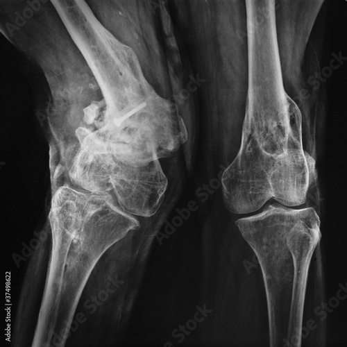 radiografia di ginocchia patologiche