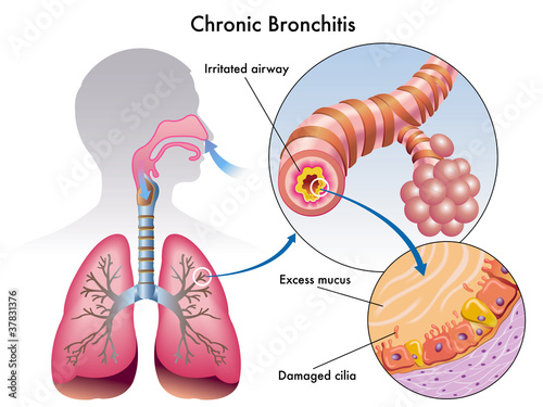 Bronchite cronica