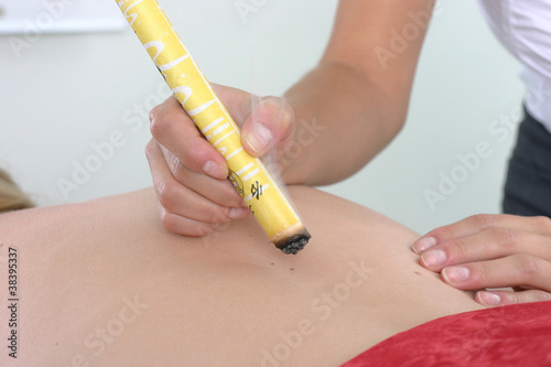 Moxibustion