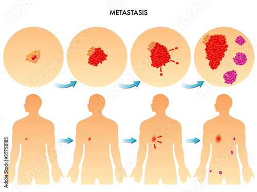 metastasi