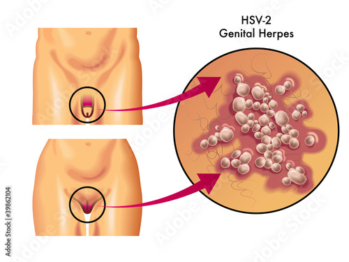 herpes genitale