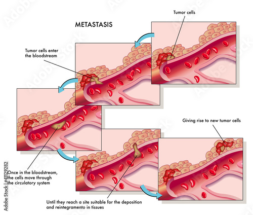 metastasi