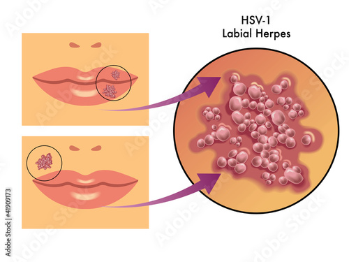 herpes labiale