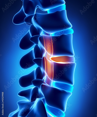 Herniated disc with pressure on spinal cord