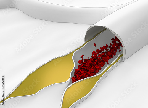 Atherosclerosis disease - plague blocking blood flow