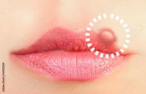 Close up of lips affected by herpes (cold sore)