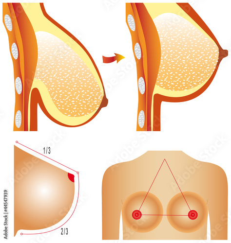 Plastic surgery of breast. Tits correction.