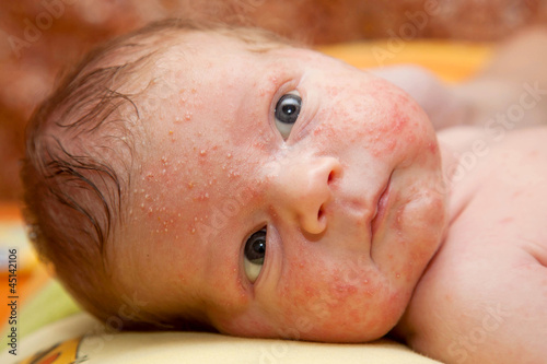 newborn baby. On face rash, acne neonatorum