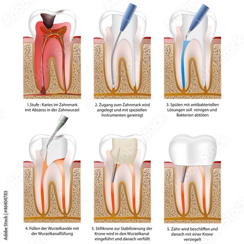 Wurzelbehandlung - root canal treatment with crown