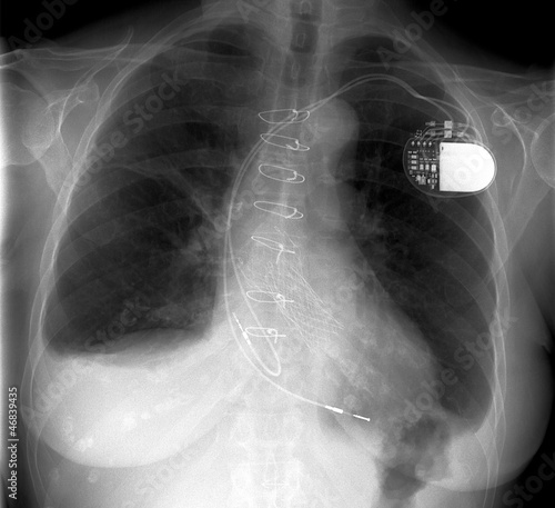 Röntgenbild Brustkorb Thorax Herzschrittmacher OP