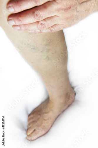 varicose veins,