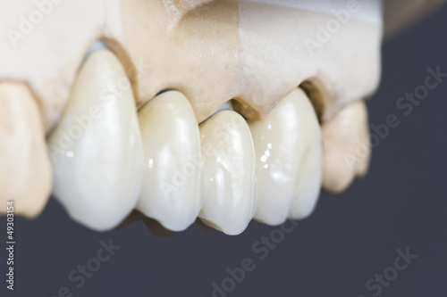 dental ceramic bridge