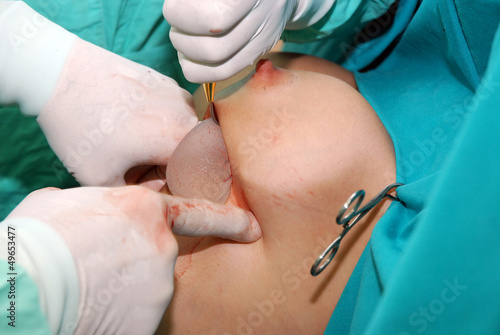 Breast augmentation surgery