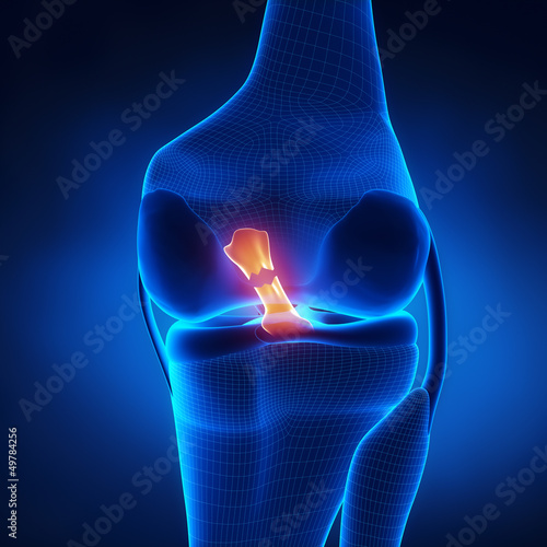 Torn Anterior Cruciate Ligament