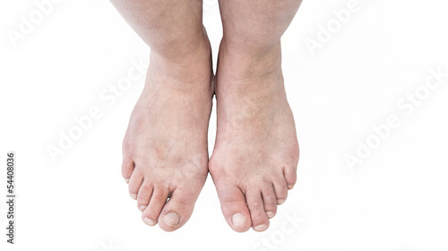 Hallux valgus