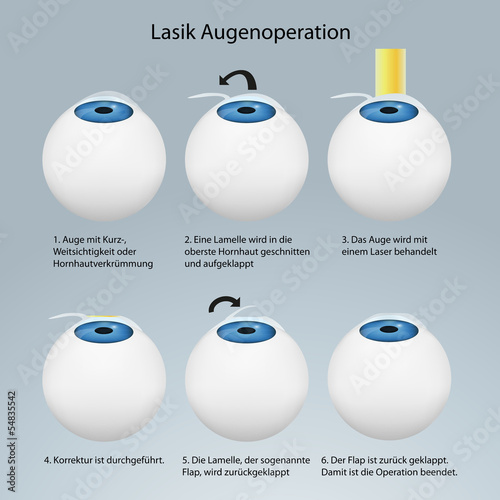 Lasik Augenoperation Funktionsweise