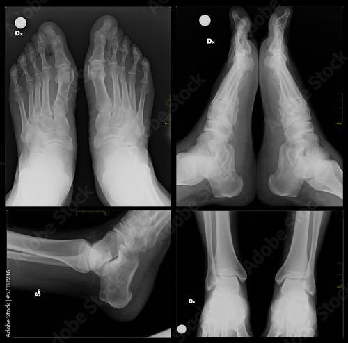 X-ray foot