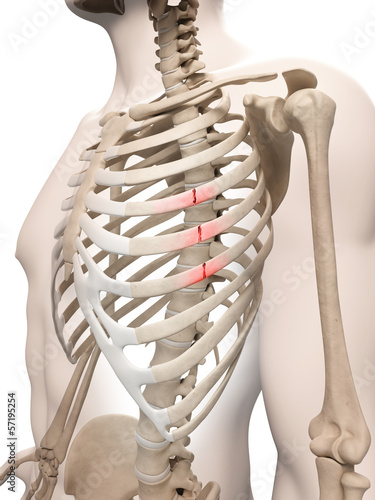 medical illustration of broken ribs