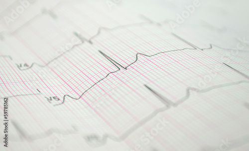 EKG