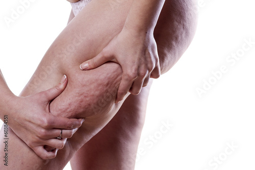 Young woman holding and pinching cellulite on her leg