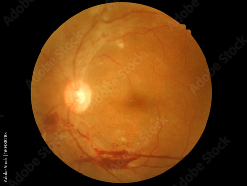 retinal of diabatic retinophaty