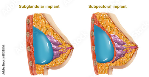 breast implant