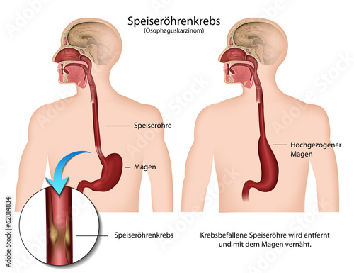 Speiseröhrenkrebs, Ösophaguskarzinom