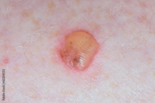 A blister wound on human caucasian skin